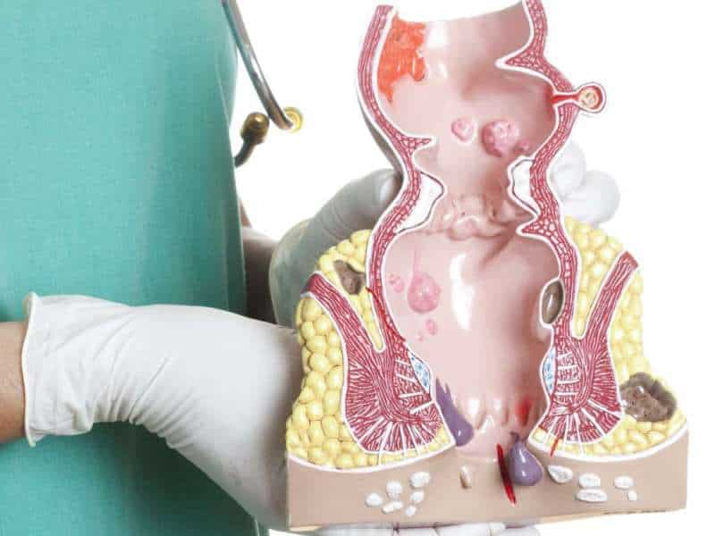 Piles Treatment New Delhi