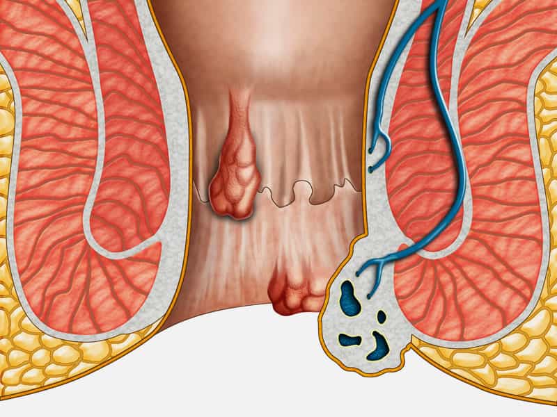 Fistula Treatment Delhi