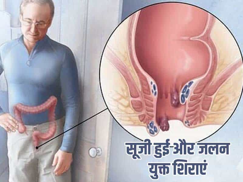 Piles Doctor in Delhi